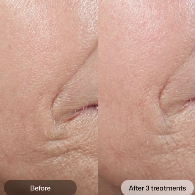 D.E.J. Bio stimulator package at Arosa Aesthetics in Reno, NV